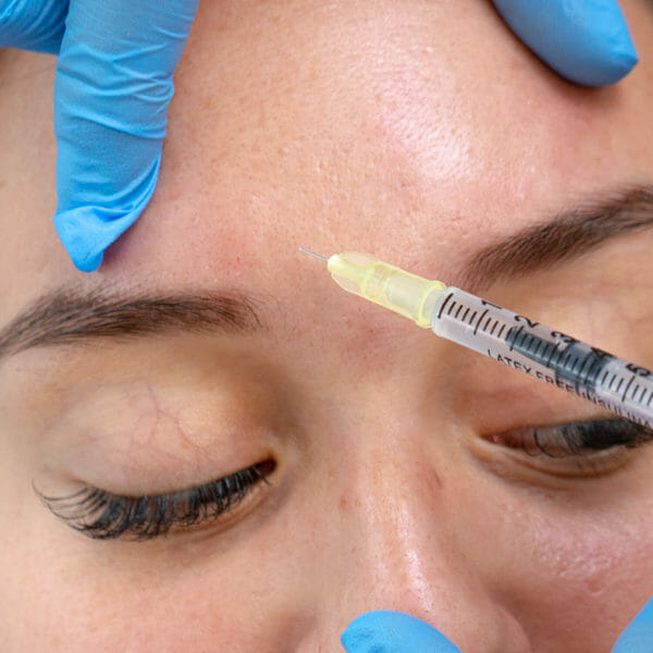 Clinica Noelia Gon - Medicina Estetica Facial - Baby Botox