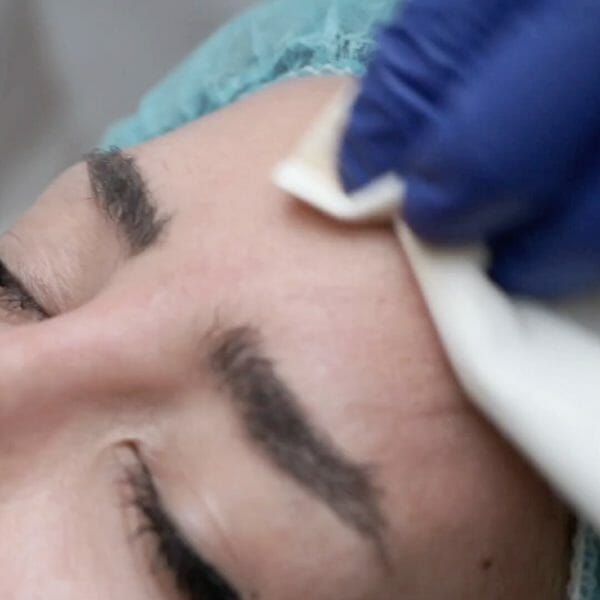 Clinica Noelia Gon - Medicina Estetica Facial - Peeling Con Fenol Tca 2