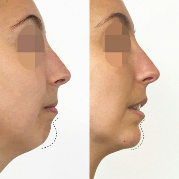Clinica Noelia Gon - Medicina Estetica Facial - Relleno De Menton 2