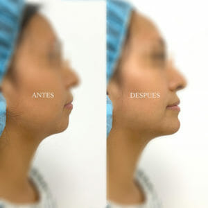 Clinica Noelia Gon - Medicina Estetica Facial - Relleno de Menton