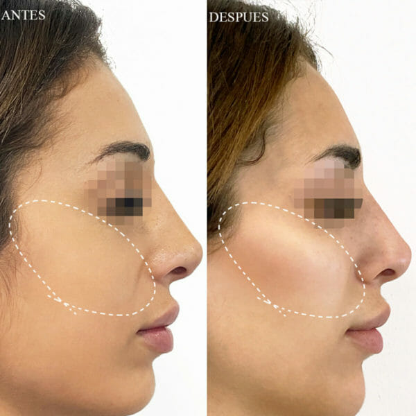Clinica Noelia Gon - Medicina Estetica Facial - Relleno De Pomulos