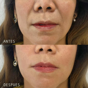 Clinica Noelia Gon - Medicina Estetica Facial - Relleno de Surcos Nasogenianos