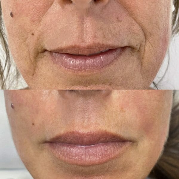 Clinica Noelia Gon - Medicina Estetica Facial - Relleno De Surcos Nasogenianos 4