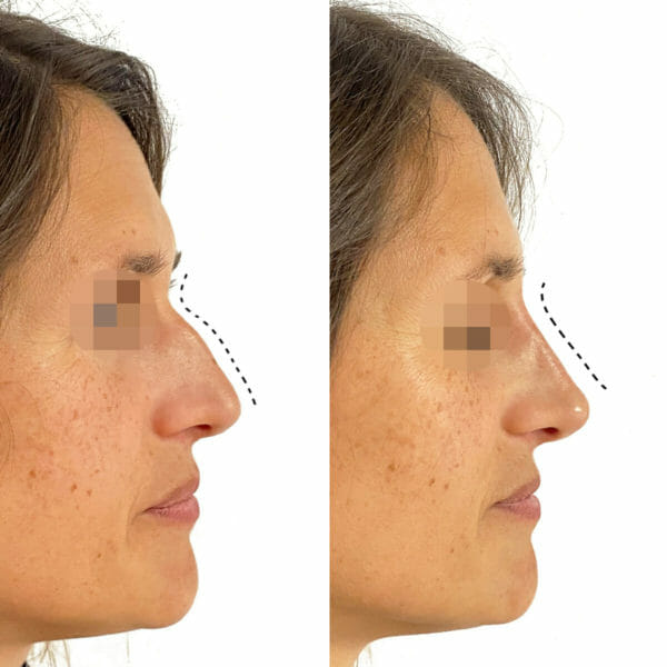 Clinica Noelia Gon - Medicina Estetica Facial - Rinomodelacion 2