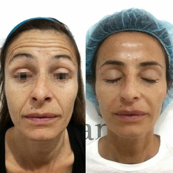 Clinica Noelia Gon - Medicina Estetica Facial - Total Face Premium
