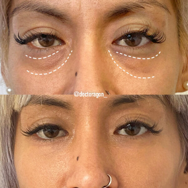 Clinica Noelia Gon - Medicina Estetica Facial - Relleno De Ojeras 3